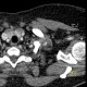 Cervical rib, compression of subclavian vein, trombosis of subclavian vein: CT - Computed tomography